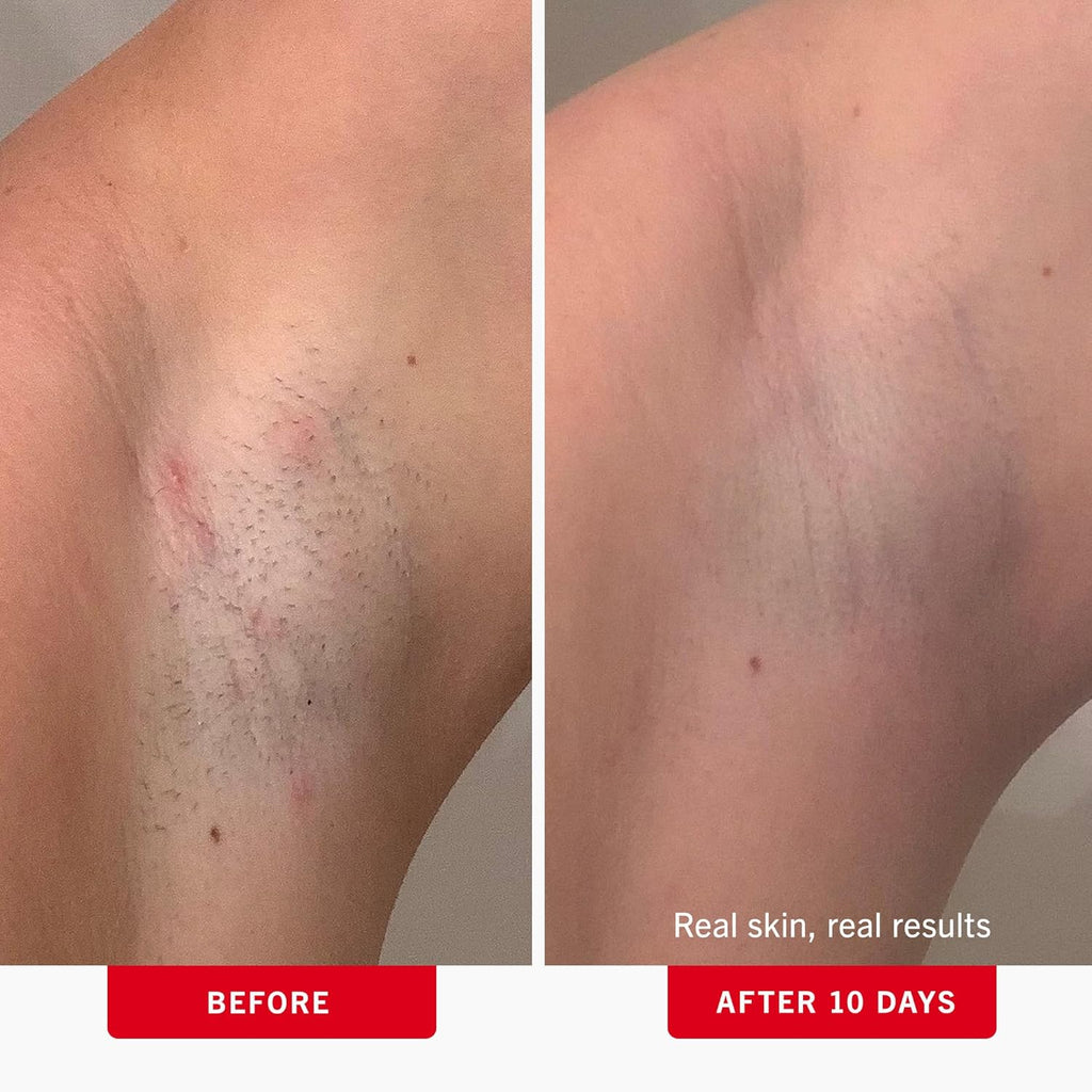 First Aid Beauty - Ingrown Hair Pads with BHA + AHA - Aftershave Treatment