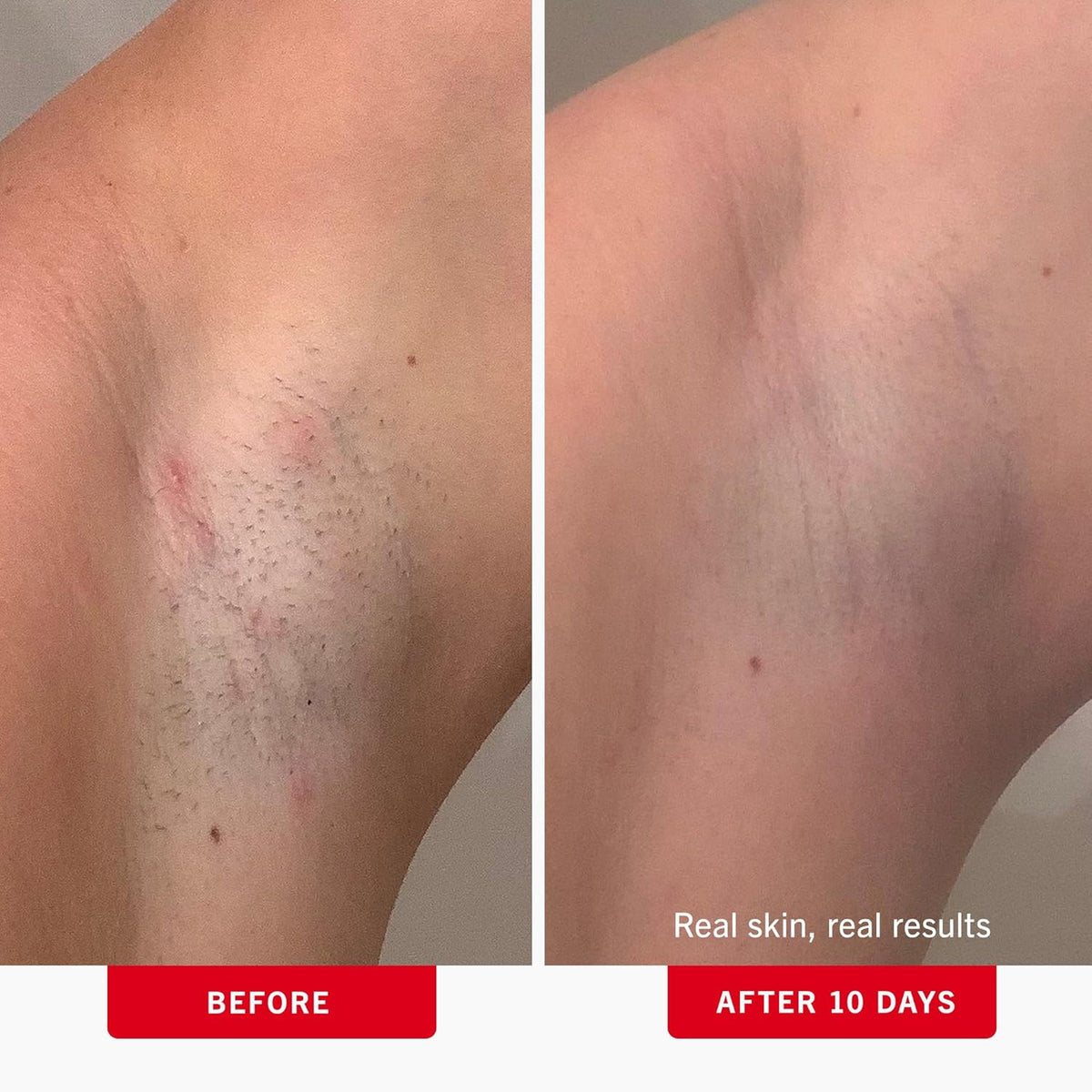First Aid Beauty - Ingrown Hair Pads with BHA + AHA - Aftershave Treatment