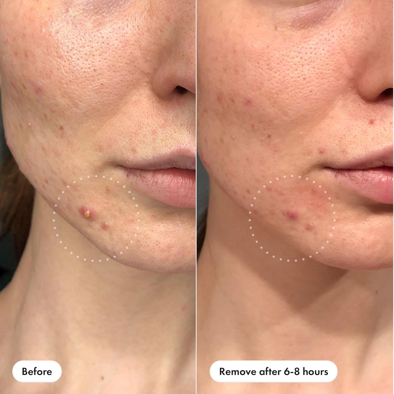 Mighty Patch™ Invisible+ Patch – The Barely-There Daytime Hydrocolloid Acne