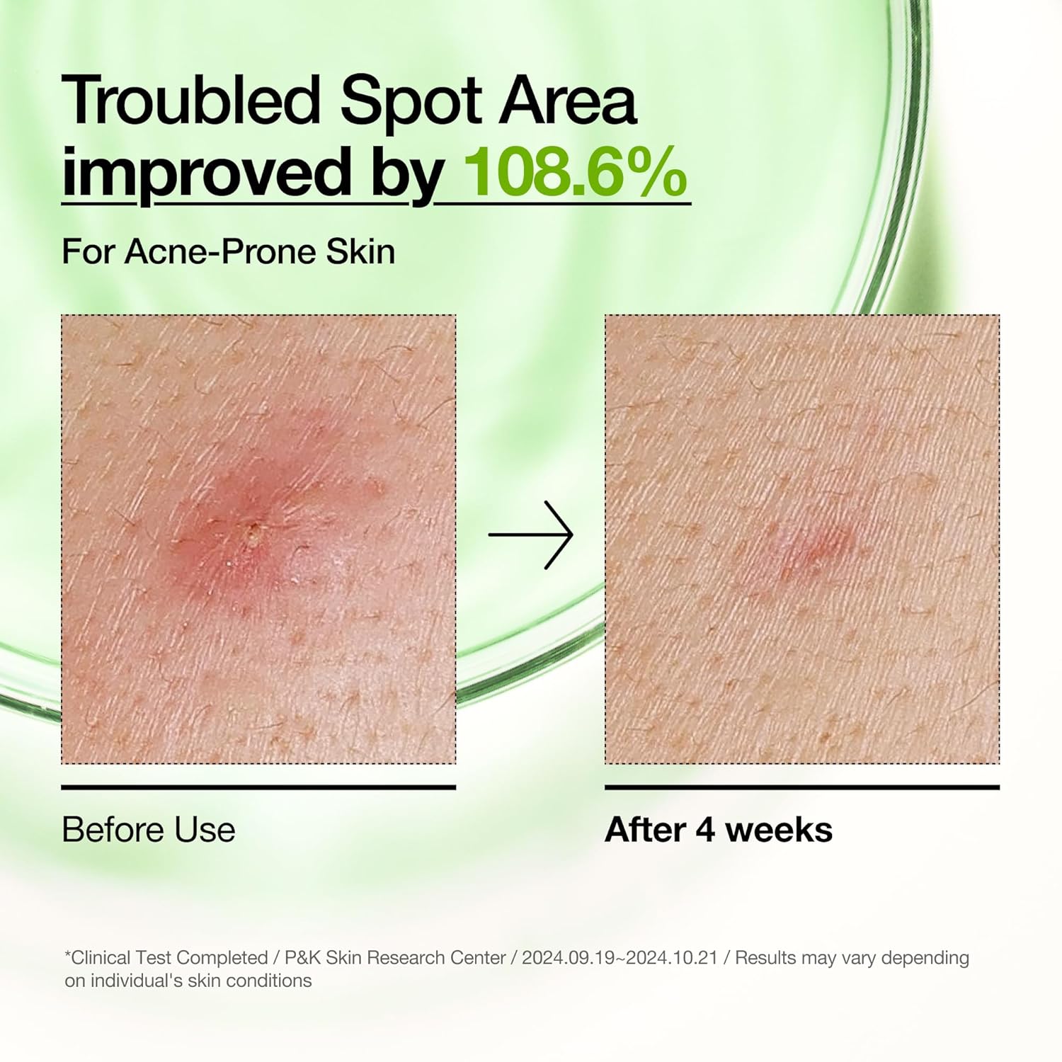 Anua Azelaic Acid 10 Hyaluron Redness Soothing Serum, Facial Serum for