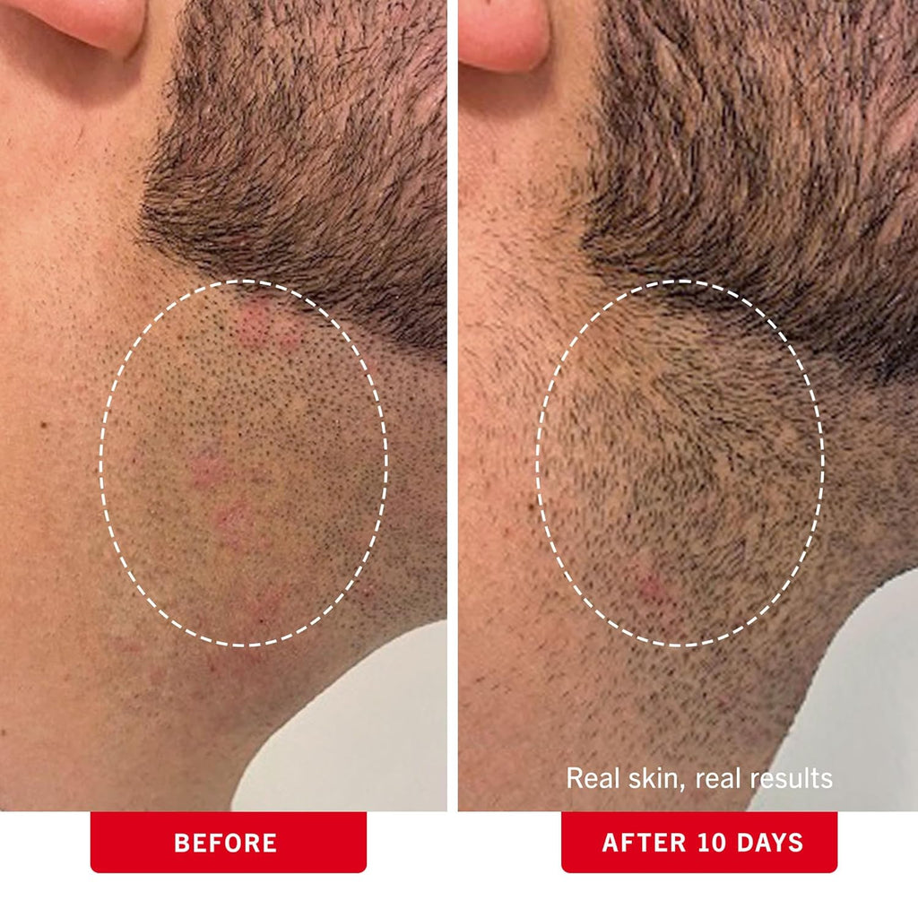 First Aid Beauty - Ingrown Hair Pads with BHA + AHA - Aftershave Treatment